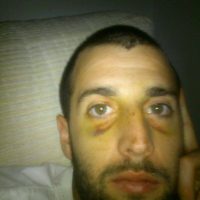 Carola with bruises under his eyes